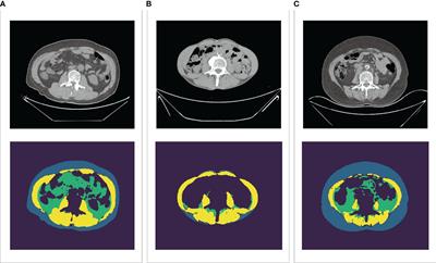 Creatinine-to-cystatin C ratio and body composition predict response to PD-1 inhibitors-based combination treatment in metastatic gastric cancer